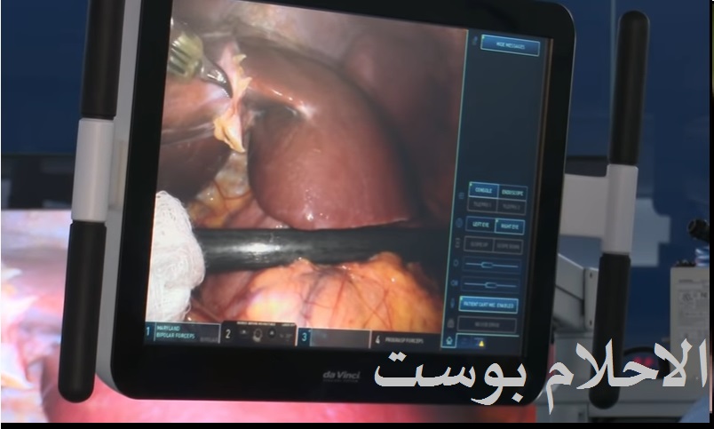 علاج الكبد 