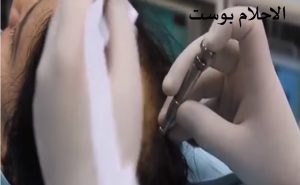 علاج زراعة الشعر