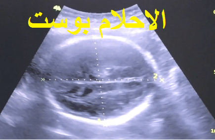 شكل البنت في السونار