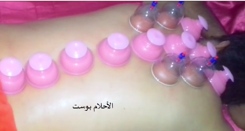 الحجامة وفوائدها 