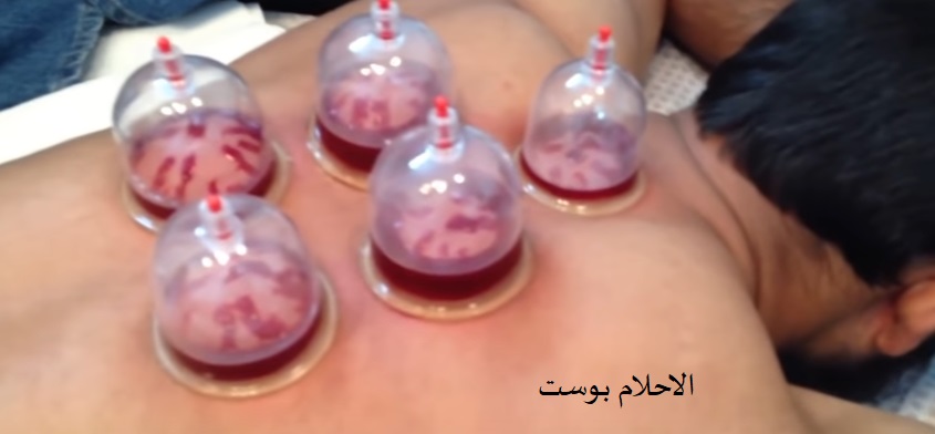 الحجامة وفوائدها 