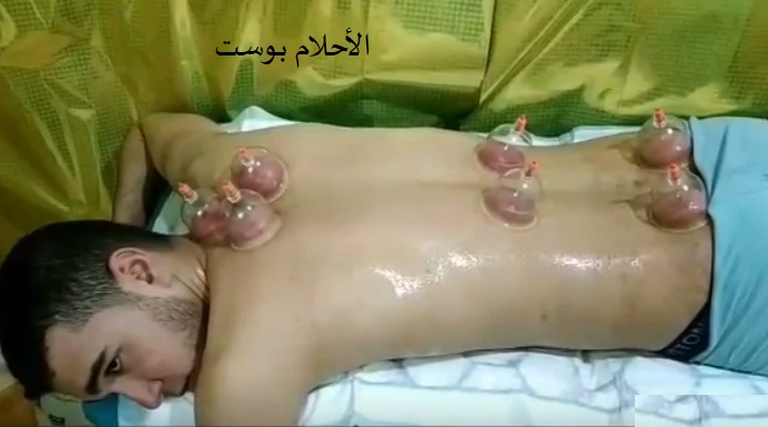 فوائد الحجامة 