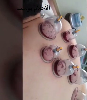 الحجامة وفوائدها