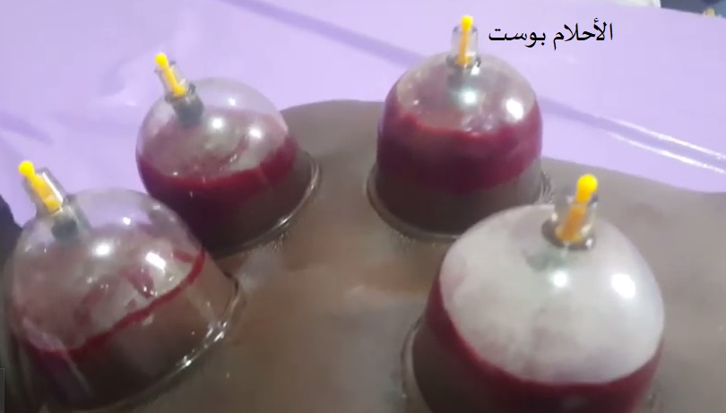 الحجامة وفوائدها 