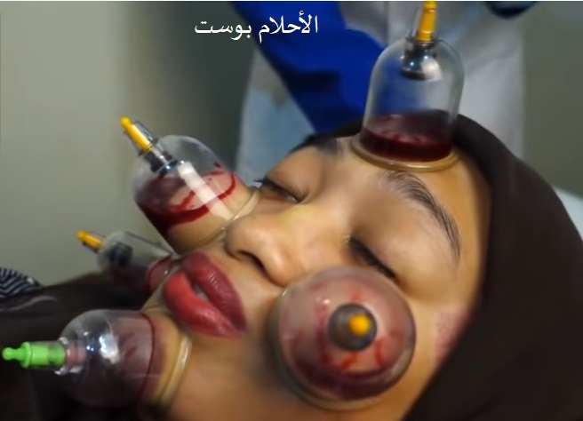 الحجامة وفوائدها 