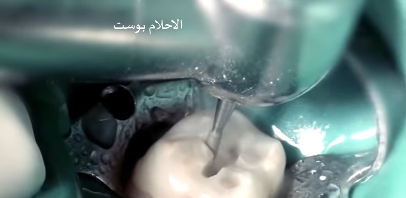 علاج تسوس الاسنان 
