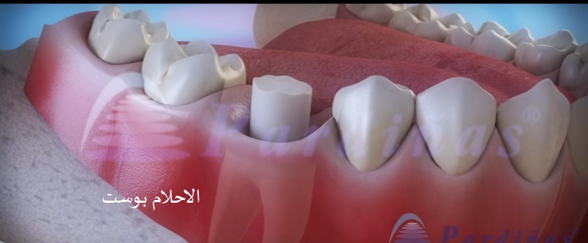 علاج تسوس الاسنان 