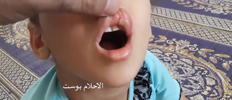 علاج تقرحات الفم 
