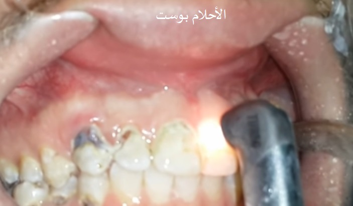 تسوس الأسنان بالليزر