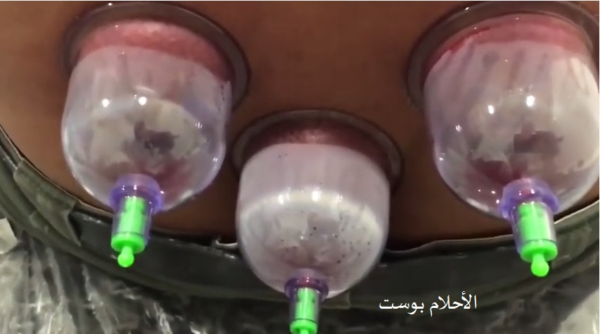 الحجامة وفوائدها 