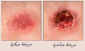 مضاعفات التهاب عنق الرحم