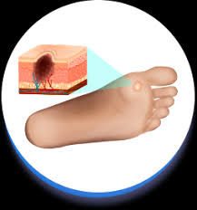 أشكال القدم السكري