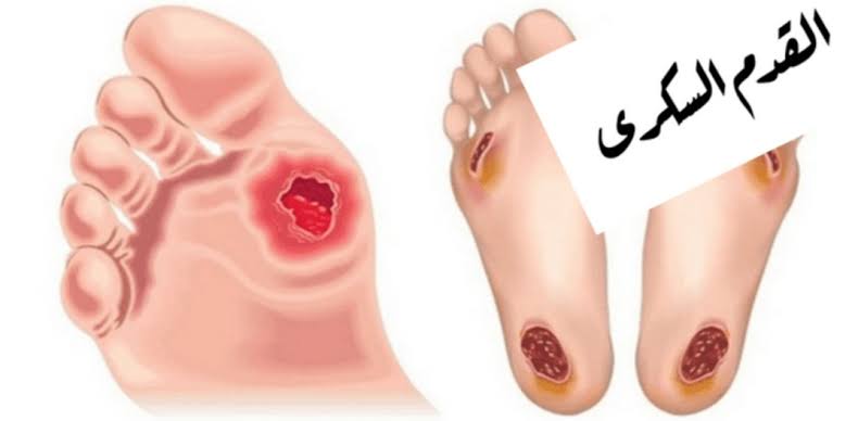 أعراض القدم السكري
