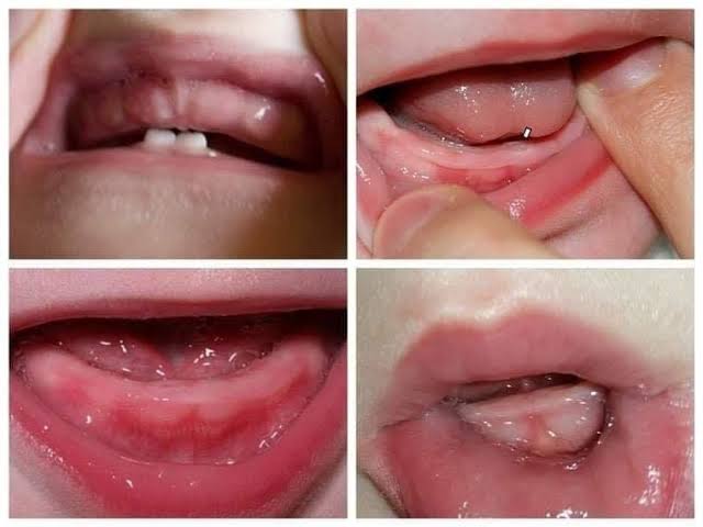 شكل لثة الأطفال عند التسنين بالصور