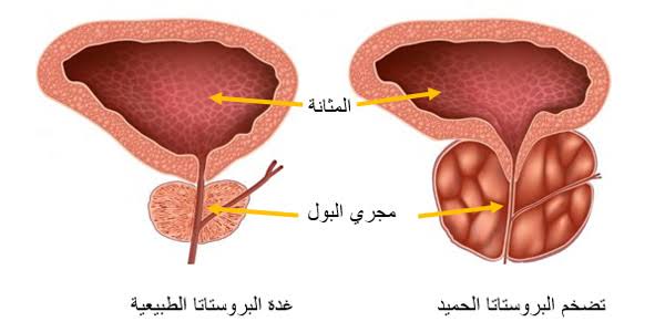 دواعي استعمال حبوب تامسولوسين