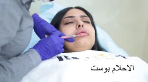 فوائد فيلر الشفايف