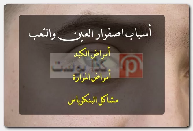 أسباب اصفرار العين