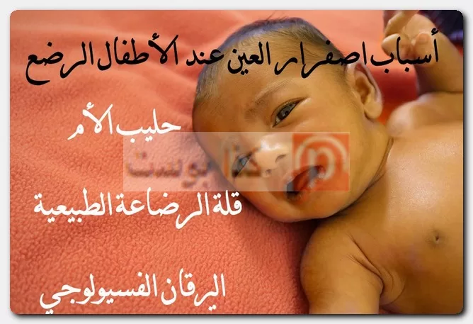 أسباب اصفرار العين