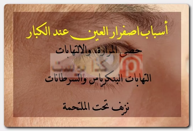 أسباب اصفرار العين