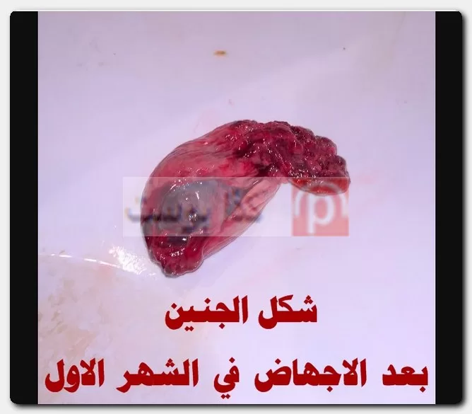 الإجهاض في الشهر الأول