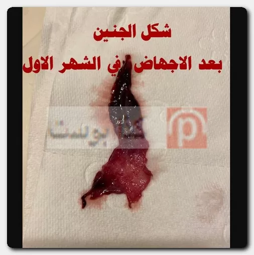 الإجهاض في الشهر الأول
