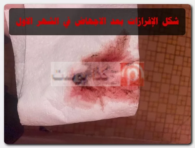 الإجهاض في الشهر الأول