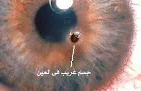 دخول جسم غريب للعين