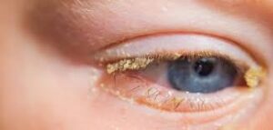 عدوى بكتيرية في العين