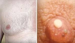 الورم تحت الاشعة