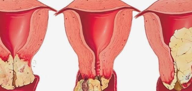 التهابات المهبل