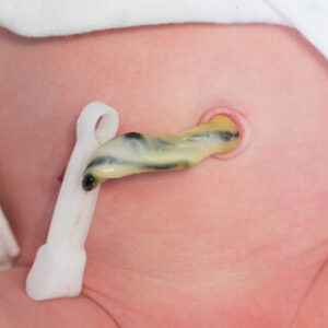 سرة المولود