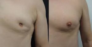 أعراض سرطان الثدي عند الرجال