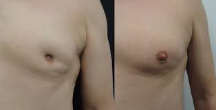 أعراض سرطان الثدي عند الرجال