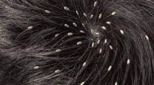 تفسير رؤية القمل الابيض في المنام