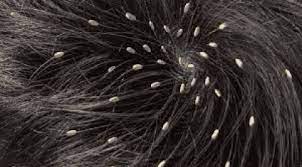 تفسير رؤية القمل الابيض في المنام