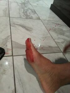 خروج الدم من القدم